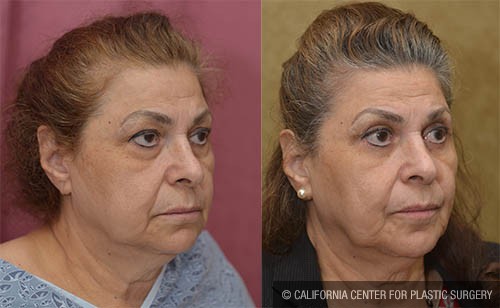 Eyelid (Blepharoplasty) Before & After Patient #13690