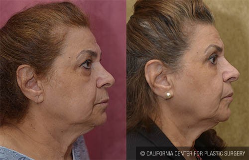 Eyelid (Blepharoplasty) Before & After Patient #13821