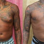 Male gynecomastia (breast) reduction Before & After Patient #13694