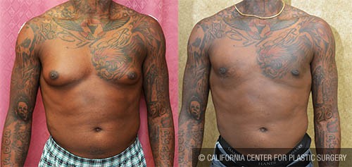 Male gynecomastia (breast) reduction Before & After Patient #13694
