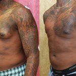 Male gynecomastia (breast) reduction Before & After Patient #13694