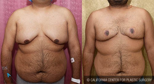 Male gynecomastia (breast) reduction Before & After Patient #13695