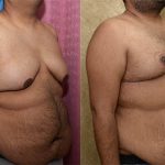 Male gynecomastia (breast) reduction Before & After Patient #13695