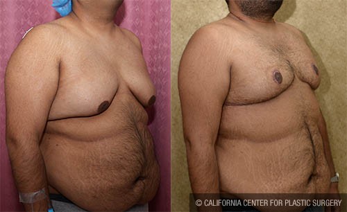 Male gynecomastia (breast) reduction Before & After Patient #13695