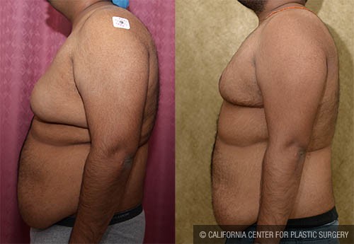 Male gynecomastia (breast) reduction Before & After Patient #13695