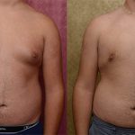 Male gynecomastia (breast) reduction Before & After Patient #13696