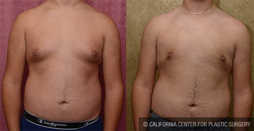 Male gynecomastia (breast) reduction Before & After Patient #13696