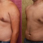 Male gynecomastia (breast) reduction Before & After Patient #13696