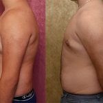 Male gynecomastia (breast) reduction Before & After Patient #13696