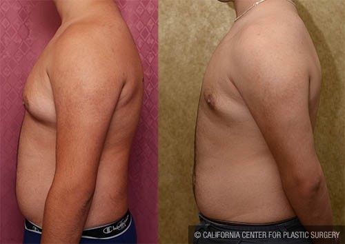 Male gynecomastia (breast) reduction Before & After Patient #13696