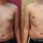 Male gynecomastia (breast) reduction Before & After Patient #13697