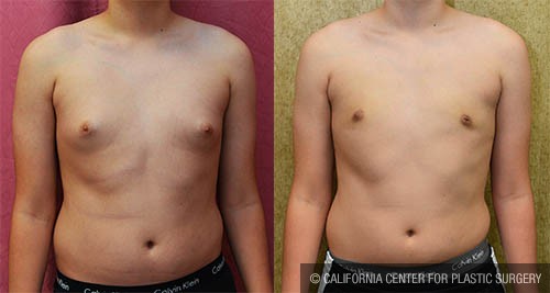 Male gynecomastia (breast) reduction Before & After Patient #13697