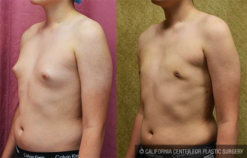 Male gynecomastia (breast) reduction Before & After Patient #13697