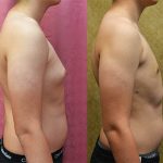 Male gynecomastia (breast) reduction Before & After Patient #13697