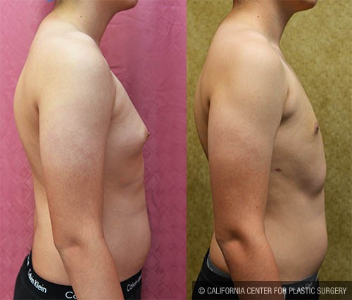 Male gynecomastia (breast) reduction Before & After Patient #13697