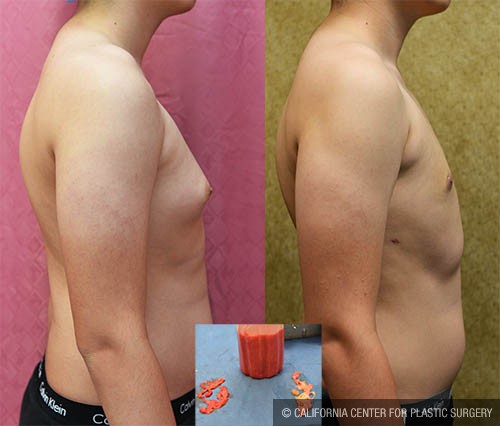 Male gynecomastia (breast) reduction Before & After Patient #13697