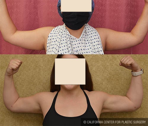 Liposuction Arms Before & After Patient #13684