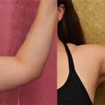 Liposuction Arms Before & After Patient #13684