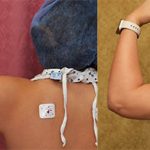 Liposuction Arms Before & After Patient #13684