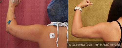 Liposuction Arms Before & After Patient #13684