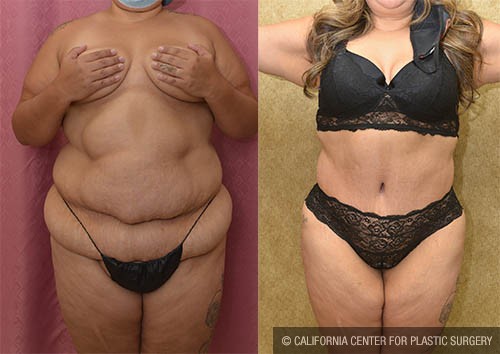 Liposuction Abdomen Plus Size Before & After Patient #13699