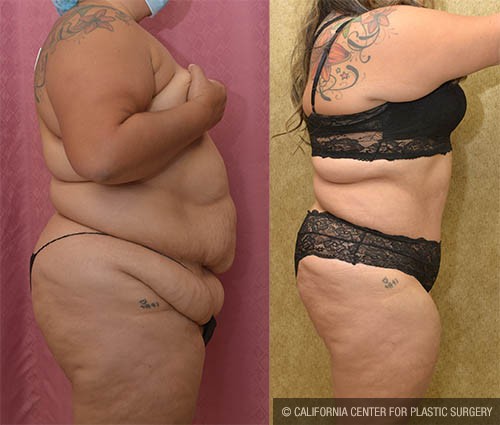 Liposuction Abdomen Plus Size Before & After Patient #13699