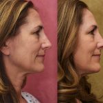 Rhinoplasty - Caucasian Before & After Patient #13700