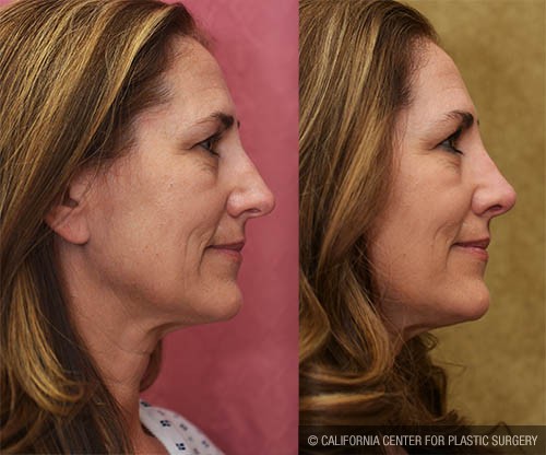 Rhinoplasty - Caucasian Before & After Patient #13700