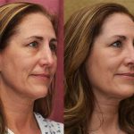 Rhinoplasty - Caucasian Before & After Patient #13700