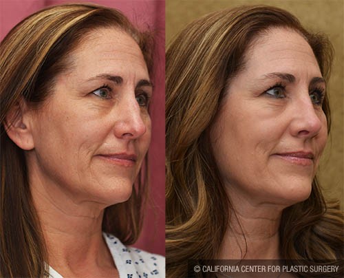 Rhinoplasty - Caucasian Before & After Patient #13700