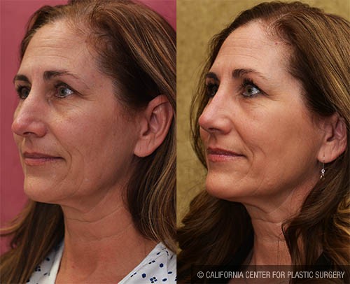 Rhinoplasty - Caucasian Before & After Patient #13700