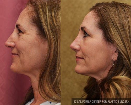 Rhinoplasty - Caucasian Before & After Patient #13700