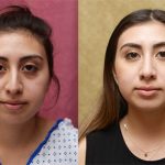 Rhinoplasty - Hispanic Before & After Patient #13702