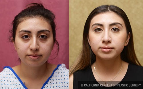 Rhinoplasty - Hispanic Before & After Patient #13702