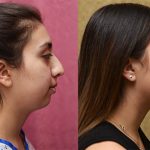 Rhinoplasty - Hispanic Before & After Patient #13702