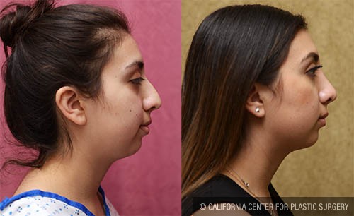 Rhinoplasty - Hispanic Before & After Patient #13702