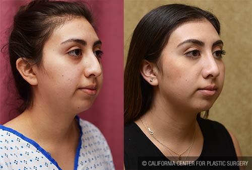 Rhinoplasty - Hispanic Before & After Patient #13702