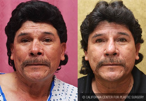 Hispanic Rhinoplasty Before & After Patient #13823