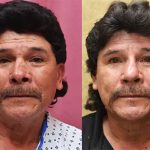 Rhinoplasty - Hispanic Before & After Patient #13701