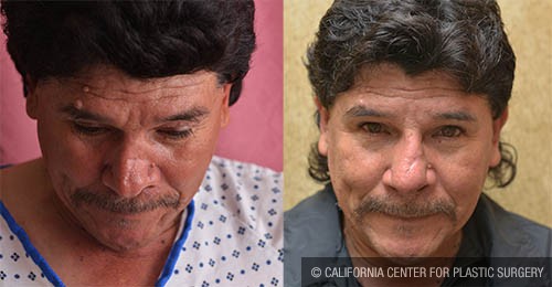 Rhinoplasty - Hispanic Before & After Patient #13701