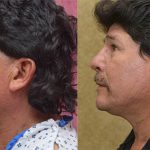 Rhinoplasty - Hispanic Before & After Patient #13701