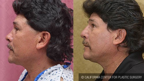 Rhinoplasty - Hispanic Before & After Patient #13701