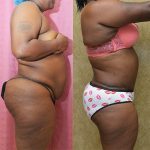 Tummy Tuck (Abdominoplasty) Small Size Before & After Patient #13704