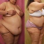 Tummy Tuck (Abdominoplasty) Super Plus Size Before & After Patient #13810