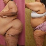 Tummy Tuck (Abdominoplasty) Super Plus Size Before & After Patient #13810