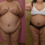 Tummy Tuck (Abdominoplasty) Super Plus Size Before & After Patient #13810