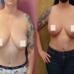 Breast Lift (Mastopexy) Before & After Patient #13987