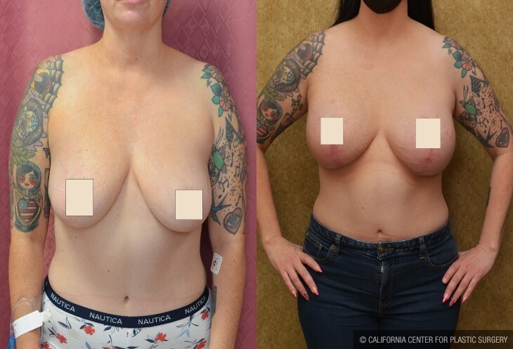Breast Lift (Mastopexy) Before & After Patient #13987
