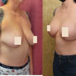 Breast Lift (Mastopexy) Before & After Patient #13987