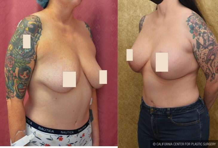 Breast Lift (Mastopexy) Before & After Patient #13987